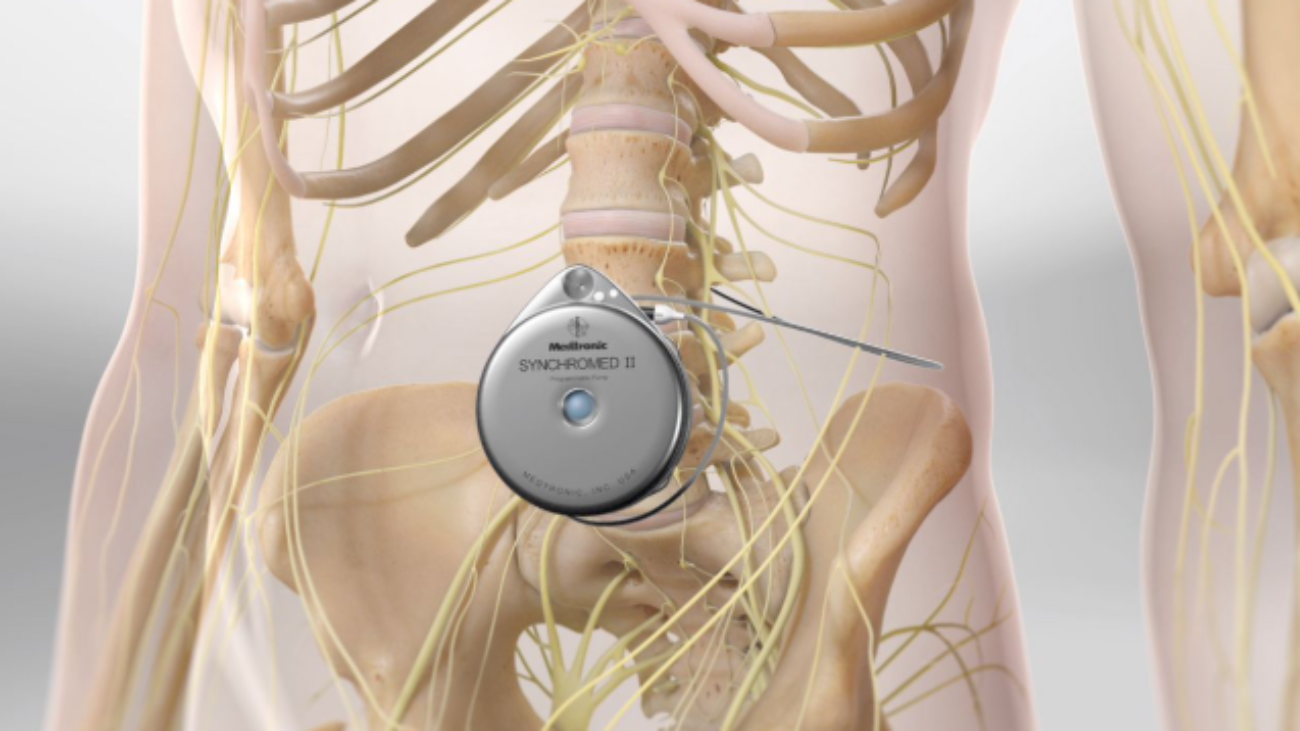 How Spinal Cord Stimulation May Help Manage Chronic Pain