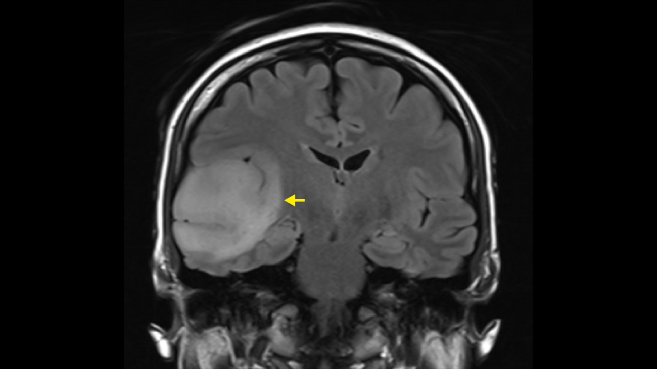 Neuroradiology's Role in Surgical Planning for Brain Disorders