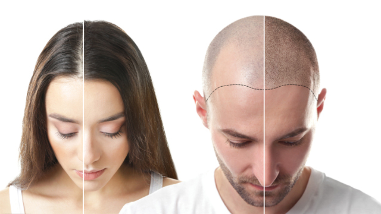 What To Expect During Scalp Micropigmentation