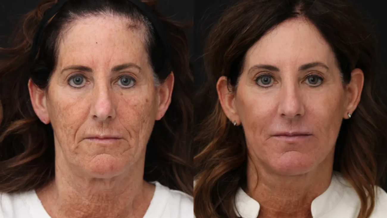 Insights Into the Mohs Surgery Process for Skin Cancer Treatment