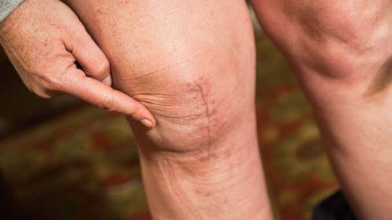 Insights into the Process of Knee Replacement Surgery